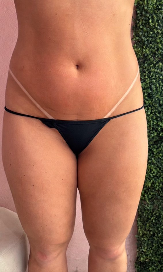 Antes da sessão de massagem modeladora, coxas e quadril